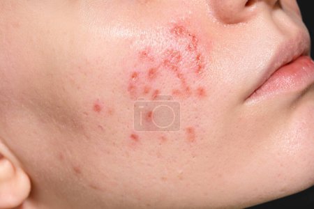 Die Zeit der Hautheilung nach dem Wiederaufleben des Erbium-Laser-Gesichts. Junge Frau leidet unter Problemhaut. Behandlung von Eispicknarben. Tag 1.