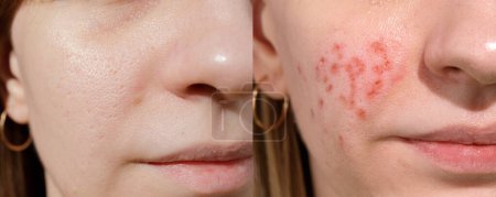 Jeune femme souffrant de problèmes de peau. Traitement des cicatrices de pic à glace. Erbium laser visage resurfaçage.