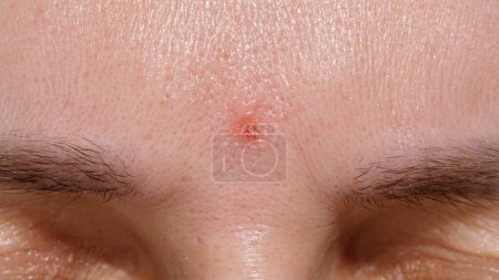 Skin healing period after erbium laser facial resurfacing. Young woman suffering from problem skin. Treatment of ice pick scars. Day 1.