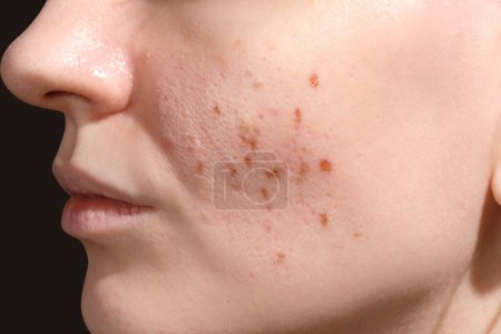 Die Zeit der Hautheilung nach dem Wiederaufleben des Erbium-Laser-Gesichts. Junge Frau leidet unter Problemhaut. Behandlung von Eispicknarben. Tag 3.