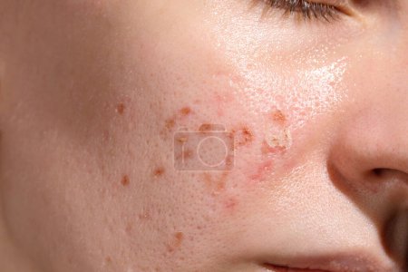 Die Zeit der Hautheilung nach dem Wiederaufleben des Erbium-Laser-Gesichts. Junge Frau leidet unter Problemhaut. Behandlung von Eispicknarben. Tag 3.