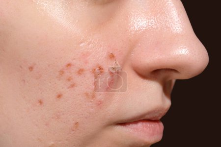 Période de guérison de la peau après la résurgence du visage au laser erbium. Jeune femme souffrant de problèmes de peau. Traitement des cicatrices de pic à glace. Jour 3.