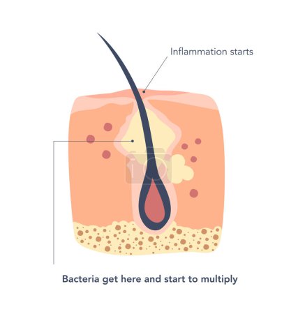 Illustration for Inflamed skin around the hair follicles deep in the pores. Second stage of inflammation, where bacteria get inside and start to multiply itself. Vector illustration - Royalty Free Image