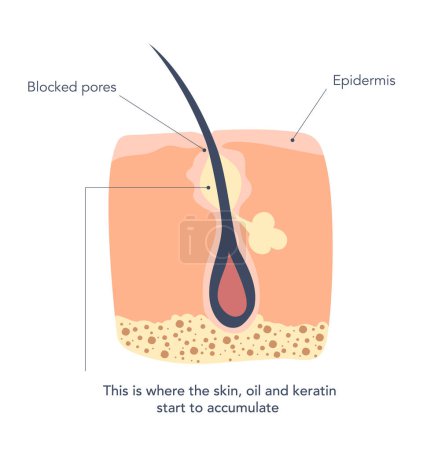 Illustration for Inflamed skin around the hair follicles deep in the pores. First stage of inflammation, where skin, oil and keratin get accumulated. Vector illustration - Royalty Free Image