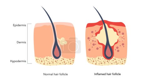 Entzündeter Follikel und normaler gesunder Haarfollikel unter dem Mikroskop. Eingewachsene Haare führen zu Rötungen und Entzündungen, die mit Pickeln einhergehen. Epidermis, Dermis, Unterhaut.