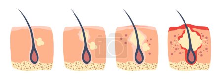 Illustration for Stages of the hair follicle inflammation in the human skin. The sebum in the clogged pore promotes the growth of a bacteria. This leads to the redness and inflammation, that associated with pimples - Royalty Free Image