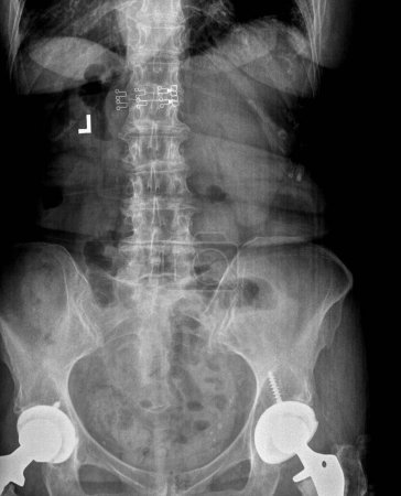 Photo for Film xray or radiograph of a lumbar spine, pelvis and hip. AP anterior posterior view showing bilateral hip replacement surgery with titanium screws - Royalty Free Image
