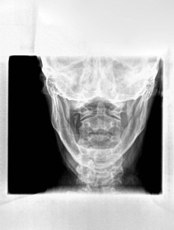 Photo for Film xray or radiograph of a cervical neck. AP open mouth anterior posterior view which is the best way to see the C1 Atlas and C2 Axis vertebrae - Royalty Free Image