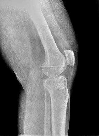 Foto de Radiografía de película o radiografía de una rodilla normal. Vista lateral muestra la estructura ósea normal de la tibia del fémur de la rótula y el peroné, el espacio articular es normal con un fabella aka ratones articulares visto en la parte posterior - Imagen libre de derechos