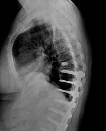 Téléchargez les photos : Radiographie ou radiographie d'une vertèbre thoracique médio-dorsale. Vue latérale montrant le support chirurgical pour aider à stabiliser les patients au milieu du dos - en image libre de droit