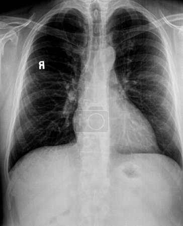 Téléchargez les photos : Radiographie thoracique du patient présentant des poumons emphysémateux, une adénopathie hilaire montrant un cœur, des vertèbres et des vaisseaux pulmonaires - en image libre de droit