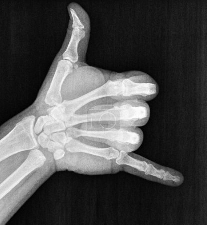 Photo for Film xray x-ray or radiograph of hand and fingers showing skelton bones doing shaka sometimes known as hang loose is a gesture with friendly intent often associated with Hawaii aloha and surf culture - Royalty Free Image