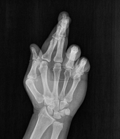 Photo for Film xray x-ray or radiograph of a hand and fingers showing Fingers crossed, hand gesture. Lie, good luck, hope, optimism superstition symbol - Royalty Free Image