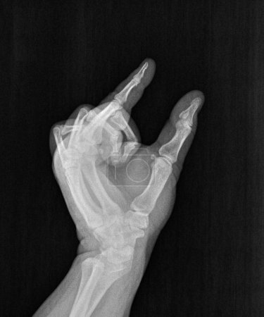 Film xray or radiograph of a hand, thumb and index pinch finger gesture for inch,  this much, or small, short, measurement, tiny, miniscule,  commonly used to describe a mini penis