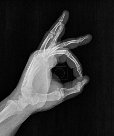 Film xray x-ray or radiograph of a thumb and finger circle associated with ok, agreement, approval, confirmation or positivity in gestural language, manual communication, or signing aka sign language