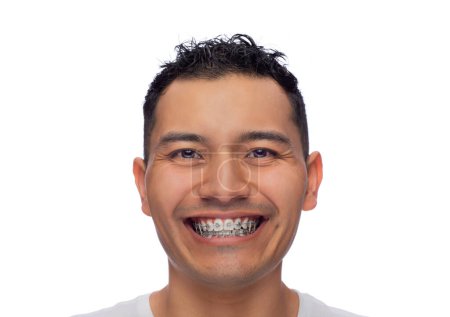 Téléchargez les photos : Visage d'un jeune latino avec des sourires de peau foncée à la caméra, montre si le traitement orthodontique, bretelles et jarretières en acier inoxydable, une personne - en image libre de droit
