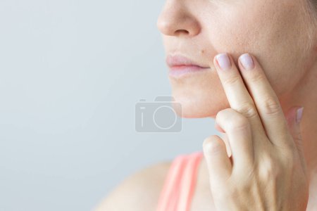 Frau mit dem Maulwurf über der Lippe. Junge Frau mit Nasolabialfalten, problematischer trockener Haut und großen Poren im Gesicht. 