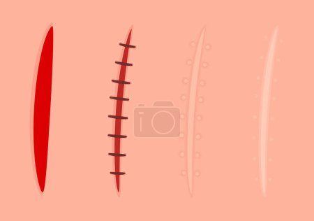 Proceso de curación. Herida fresca, suturas quirúrgicas y cicatriz cicatrizada. Dibujos animados vector clip arte ilustración conjunto.