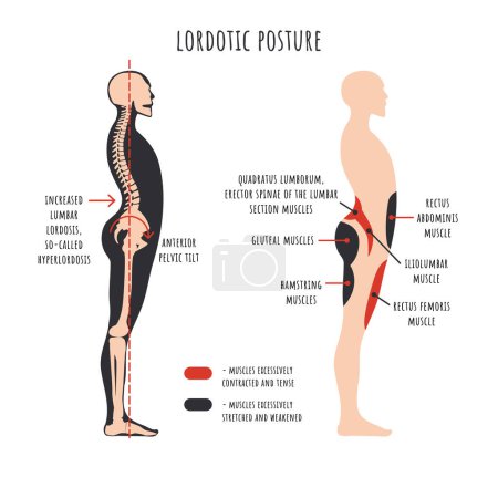 Illustration for Posture disorders infographics. Lordotic posture. Side view shows hyperlordosis deformation, spine curvature, pelvis rotation, stretched and weakened, shortened and tens muscles. Vector illustration. - Royalty Free Image