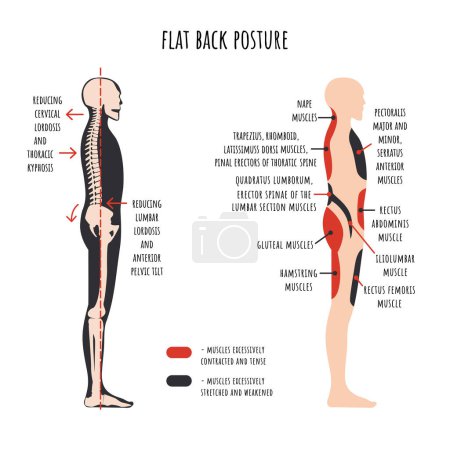 Illustration for Posture disorders infographics. Flat back posture. The side view shows characteristic decrease natural curves of spine, pelvis rotation, stretched and weakened, shortened and tens muscles. Vector. - Royalty Free Image