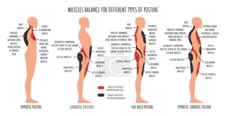 Illustration for Comparison of muscle imbalance in various postural disorders. Kyphotic, lordotic, flat back posture infographics. The side view shows characteristic stretched and weakened, shortened and tens muscles - Royalty Free Image