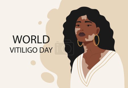Illustration for Young afro american girl illustration with vitiligo banner. World Vitiligo Day. Love yourself. Template for international Vitiligo Day. - Royalty Free Image