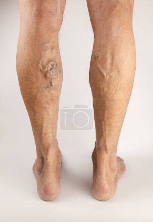 Venas varicosas en piernas de hombre. Tratamiento de venas varicosas