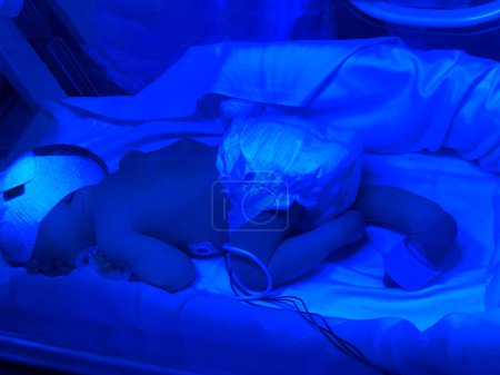 Téléchargez les photos : Bébé né prématurément, se trouve dans un incubateur d'hôpital, sous rayonnement ultraviolet - en image libre de droit