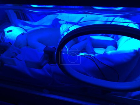 Téléchargez les photos : Bébé né prématurément, se trouve dans un incubateur d'hôpital, sous rayonnement ultraviolet - en image libre de droit