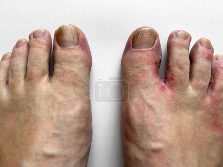 Füße mit Anzeichen einer Hautinfektion zwischen den Zehen. Infektionen, die unter die Haut gehen, durch eine Pilzerkrankung