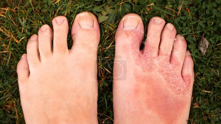              Enfermedades de la piel en las piernas. Tratamiento de enfermedades de la piel utilizando la naturaleza. Piernas con piel afectada, sobre hierba verde                    