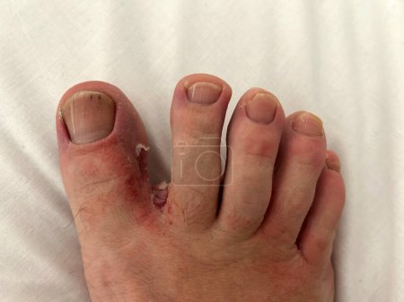 Fuß mit Anzeichen einer Hautinfektion zwischen den Zehen. Infektionen, die unter die Haut gehen, durch eine Pilzerkrankung
