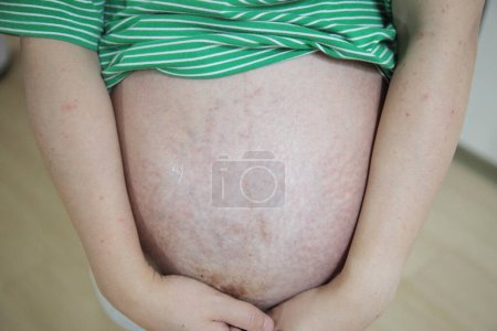 Foto de Abrazando maternidad asiática embarazada mujer con estrías marcas con amor sostiene vientre - Imagen libre de derechos