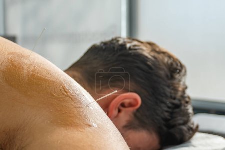 Photo for Close up of a needle stuck into the shoulder with gel of a patient lying face down - Royalty Free Image
