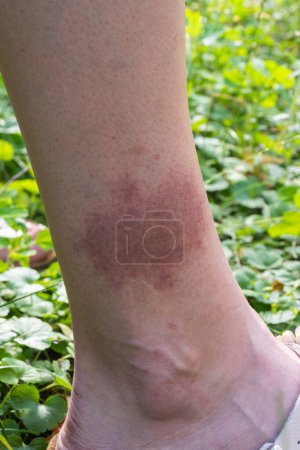 Téléchargez les photos : Une grande tache rouge sur la jambe après une morsure de tique sur le fond d'herbe, La maladie de Lyme. Photo de haute qualité - en image libre de droit
