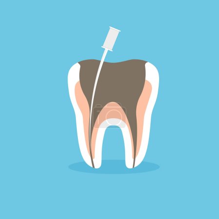 Endodontische Wurzelreinigung und Kariesbehandlung. Zahngesundheit. Vektor-Illustration im trendigen flachen Stil.