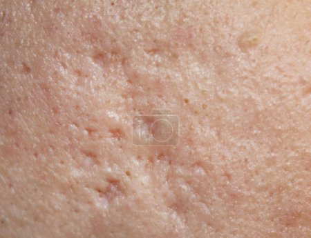 Téléchargez les photos : Problème de peau avec des marques d'acné. Stock texture de la peau humaine dans la meilleure qualité. Photo avec cicatrices. - en image libre de droit