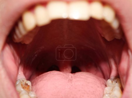 Photo for Open mouth with rotten wisdom teeth. Wisdom teeth removal concept. Stock photo of treatment at the dentist. - Royalty Free Image