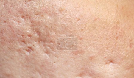 Téléchargez les photos : Problème de peau avec des marques d'acné. Stock texture de la peau humaine dans la meilleure qualité. Photo avec cicatrices. - en image libre de droit