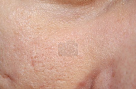 Téléchargez les photos : Pores élargis sur le visage et cicatrices d'acné. Dermatologie photos de stock de la meilleure qualité. - en image libre de droit