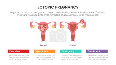 Ilustración de Concepto de infografía ectópica de embarazo o embarazo para presentación de diapositivas con ilustración vectorial de lista de 3 puntos - Imagen libre de derechos