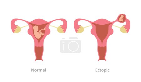 Illustration for Ectopic pregnancy pregnancy problem with comparison with normal pregnancy with modern flat style vector illustration - Royalty Free Image