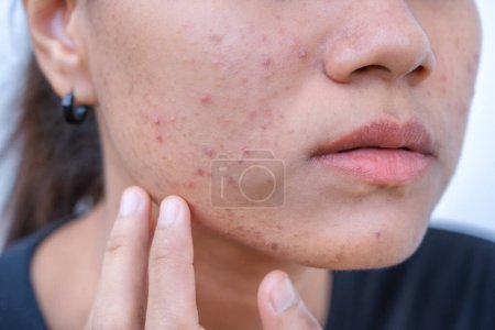 Primer plano de mujer asiática joven preocuparse por su cara cuando ella tiene problemas con la piel en su cara. Problemas con el acné y la cicatriz en la piel femenina. Problema de cuidado de la piel y concepto de salud.