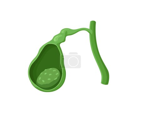 Illustration for Illustration of the gallbladder mass. Vector image of the gallbladder cancer - biliary adenocarcinoma - Royalty Free Image