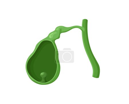 Illustration for Illustration of the gallbladder polyp. Vector image of the gallbladder with benign mass withing its cavity - Royalty Free Image