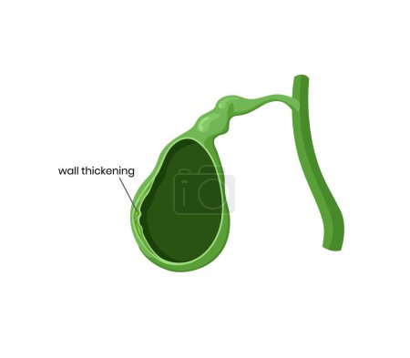 Illustration for Illustration of the gallbladder wall thickening. Vector immage of the gallbladder anatomy with thick wall. Local cholecystitis vector. - Royalty Free Image