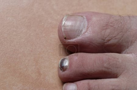 Téléchargez les photos : Bottes mal ajustées ont causé un ongle d'orteil pour devenir noir - en image libre de droit