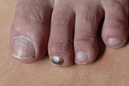 Photo for Blood pooling under a toe nail causes it to look black - Royalty Free Image