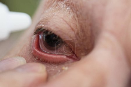Photo for A man's pupil is still dilated after IOL surgery, an intraocular lens replacement. He is having his first eye drops. His eye is very red - Royalty Free Image