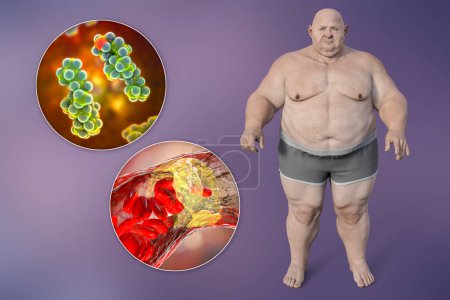 Photo for Obesity and atherosclerosis, 3D illustration showing an obese person, cholesterol molecule, atheromatous plaque inside artery leading to its narrowing as a result of metabolic disorders - Royalty Free Image